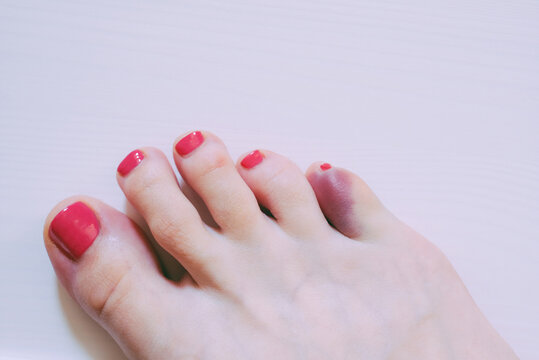 Foot with broken pinky toe caused by forceful impact with furniture. Baby toe fracture and hematoma.