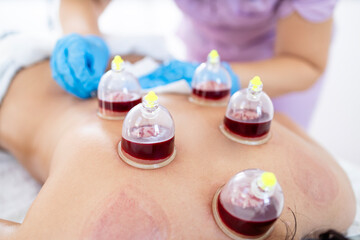 Obraz na płótnie Canvas Wet cupping or bloodletting hijama treatment performed on patient back.