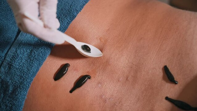 Treatment with leeches. A doctor performs a hirudotherapy procedure for a man. A doctor plants leeches on a man's back. The help of leeches for the treatment of the body. Alternative medicine.