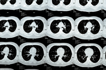 Multi slice CT scan of the chest showing normal study, normal appearance of the lungs, parenchyma,...