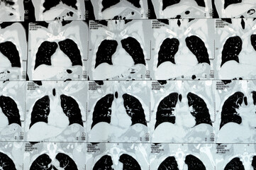 Multi slice CT scan of the chest showing normal study, normal appearance of the lungs, parenchyma,...