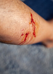 Dog bites leg  bleeding wound