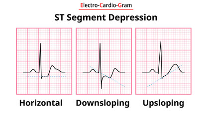ECG Morphology of ST Segment Depression - Horizontal, Upsloping, and Downsloping - Medical Electrocardiogram Vector Illustration - obrazy, fototapety, plakaty