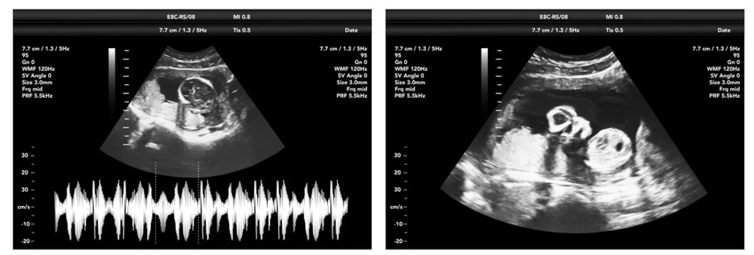 pregnancy ultrasound film genecology sonogram, baby medical ultra scan diagnostic control