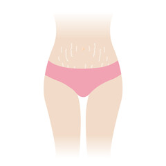 Stretch marks on tummy vector illustration isolated on white background. The white stretch marks appear on the abdomen, mid stomach, belly of woman body. Skin care and beauty concept.