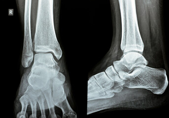 Plain x-ray AP Lateral views of the right ankle showing syndesmotic ankle sprain, an injury to one...