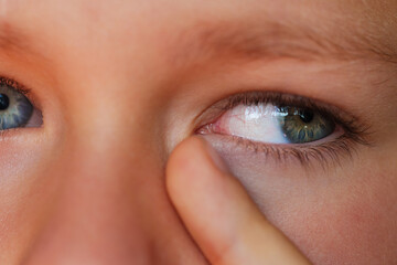 Fototapeta premium Allergic boy scratching his eyes close-up view