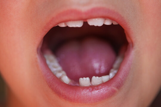 Open mouth of a child with a loose baby tooth