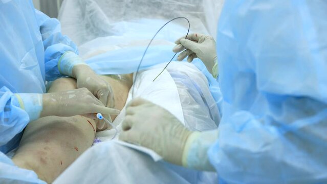 Installation catheter in cavity affected vein supply radio signal in treatment varicose veins with radiofrequency coagulation. Gentle method treatment varicose veins saphenous veins lower extremities