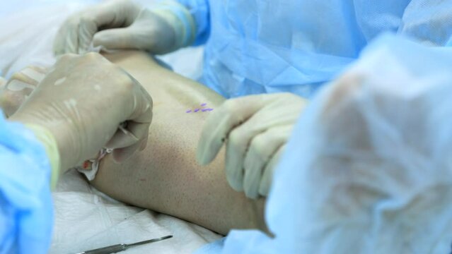 Phleboextractor surgeon removes from small hole in the patient's leg the affected part of the vein for the treatment of varicose veins. Surgeon and assistant perform surgery to remove varicose veins