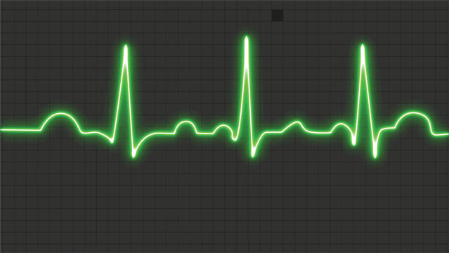 ECG paper with a normal sinus rhythm is a vector medical illustration. Recorded by an electrocardiogram is a neon human heart in normal sinus rhythm. Bright and striking style