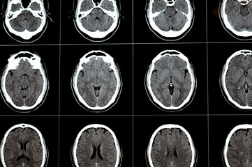 Brain CT scan showing brainstem cavernoma, right centrum semiovale developmental venous anomaly,...