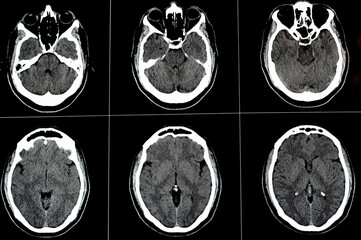 Brain CT scan showing brainstem cavernoma, right centrum semiovale developmental venous anomaly,...