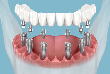 Mandibular prosthesis with gum All on 6 system supported by implants. 3D illustration of human teeth and dentures concept