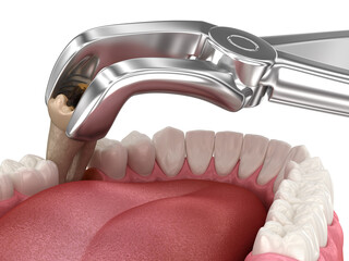 Extraction of Molar tooth damaged by caries. Dental 3D illustration