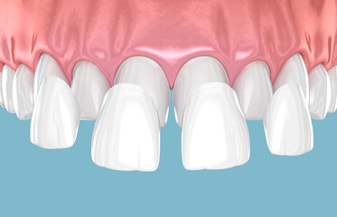 Dental veneer placement over frontal teeth. 3D illustration - 632928993