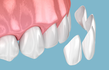 Dental veneer placement over frontal teeth. 3D illustration - 632929152