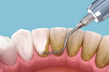 Oral hygiene: Scaling and root planing (conventional periodontal therapy). Medically accurate 3D illustration of human teeth treatment - 632929156