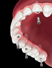 Maxillary prosthesis based on 6 implants. Dental 3D illustration