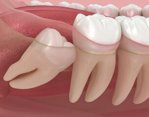 Abnormal position of wisdom teeth. Medically accurate tooth 3D illustration - 632930516
