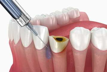 Local Dental anesthesia near damaged tooth. 3D illustration of dental treatment