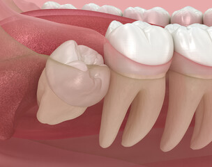Abnormal position of wisdom teeth. Medically accurate tooth 3D illustration