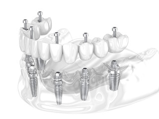 Dental prosthesis supported by six implants. Dental 3D illustration