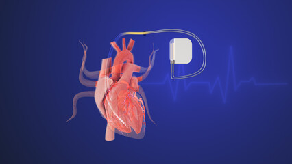 Artificial heartbeats in a cardiac pacemaker with heartbeat wave lines	
