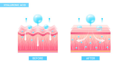 Hyaluronic acid serum drop blue absorbed into the skin cell. Before and after process of getting skin younger with help of moisturizer collagen. Solution for cosmetic advertising. 3D Vector EPS10.