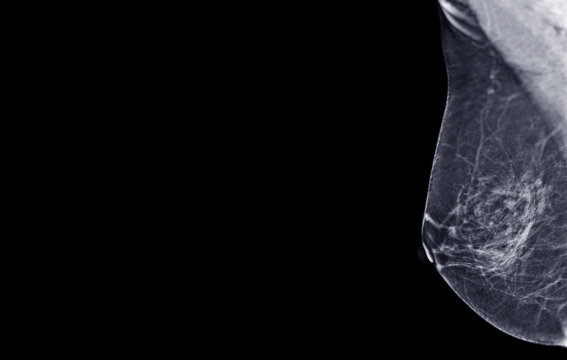 X-ray Digital Mammogram of Right  side  MLO view .