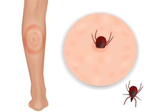 Lyme disease or Lyme borreliosis, is a disease caused by Borrelia bacteria. Erythema migrans