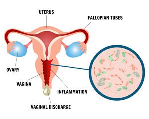 Obraz premium Medical infographic gynecology symptoms of bacterial vaginosis, vaginal discharge 