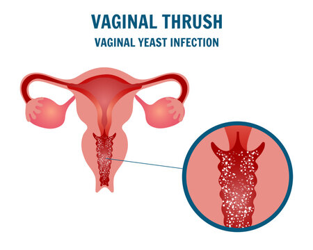 Gynecology disease, vaginal thrush infection, medical infographic 