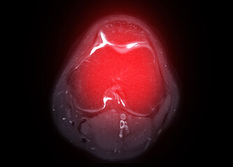 Magnetic resonance imaging or MRI of  knee joint Axial T2 FS view for detect tear or sprain of the...