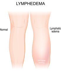 Lymphedema. lymphoedema. Healthy leg, and lymphatic edema