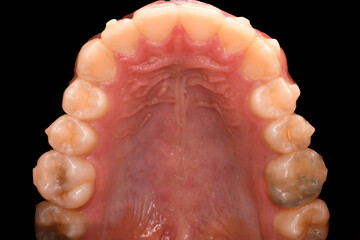 Intra oral photography of a maxillary arch in  palatal view - 633390398