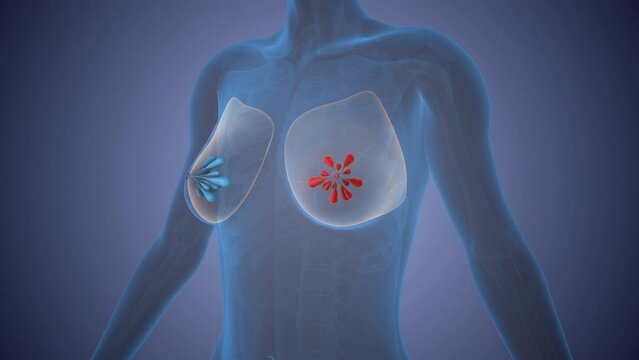 Conceptual representation of breast cancer cells