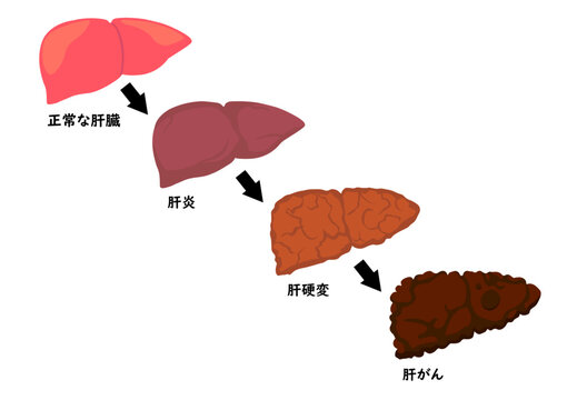 肝臓の病気の進行