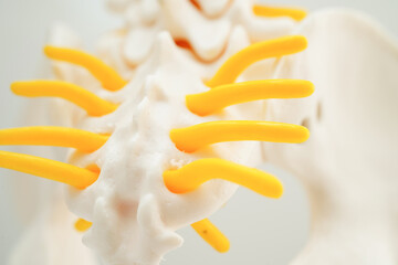 Spinal nerve and bone, Lumbar spine displaced herniated disc fragment, Model for treatment medical...