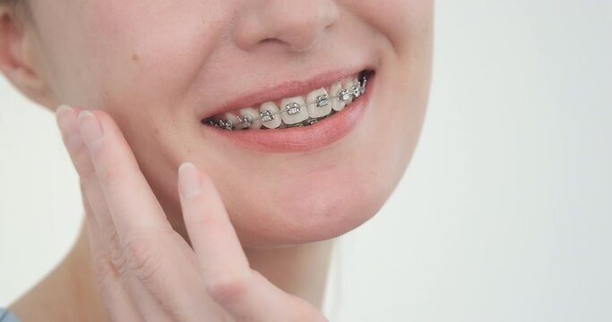 Woman smile with oral teeth braces, crop face. Orthodontic care with teeth braces on white background. Happy beautiful female patient have dentist treatment joy. Satisfied client in dental clinic