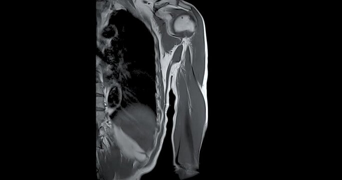 MRI Left humerus bone Coronal  T2W  for diagnosis bone tumor. 
