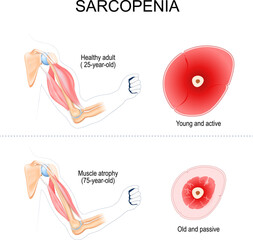 sarcopenia. muscle atrophy - obrazy, fototapety, plakaty