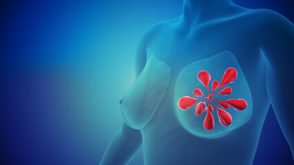 Conceptual visualization of breast cancer