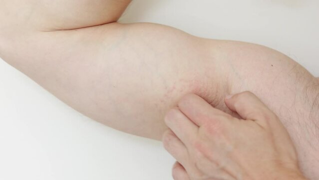 Armpit rash, Acne or red spots. Unrecognisable man scratches irritation by hand on sensitive skin after using a razor, trimmer, deodorant or antiperspirant. Allergy, irritation or atopic dermatitis.
