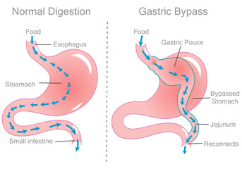 Gastric bypass surgery jejunum. Stomach reduction by pass, operation. For obesity, diabetes surgery. Cross section anatomy, diagram. Digestion illustration vector - obrazy, fototapety, plakaty