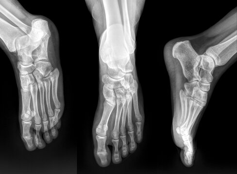 X ray of foot. Female phalanx x ray