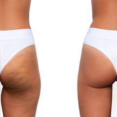 Young woman's thighs and buttocks with cellulite before and after treatment isolated on white...