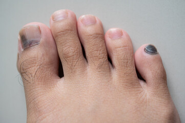 Cropped shot view of black nail called runner's toe. Runner's Toe can be described as toenail...