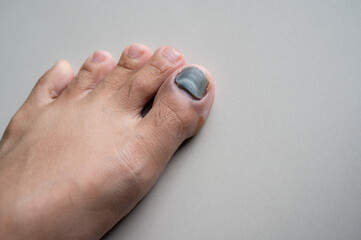 Cropped shot view of black nail called runner's toe.