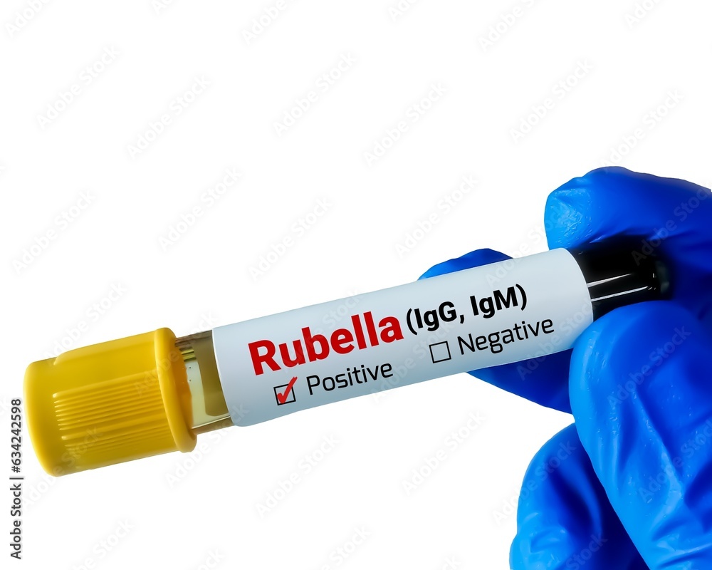 Poster blood sample for rubella (igg, igm) test